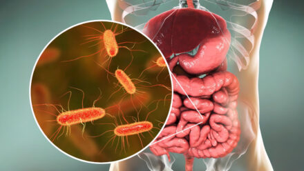 СИБР (синдром избыточного бактериального роста): что это, симптомы, диета и лечение
